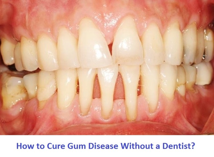 How to cure gum disease without a dentist